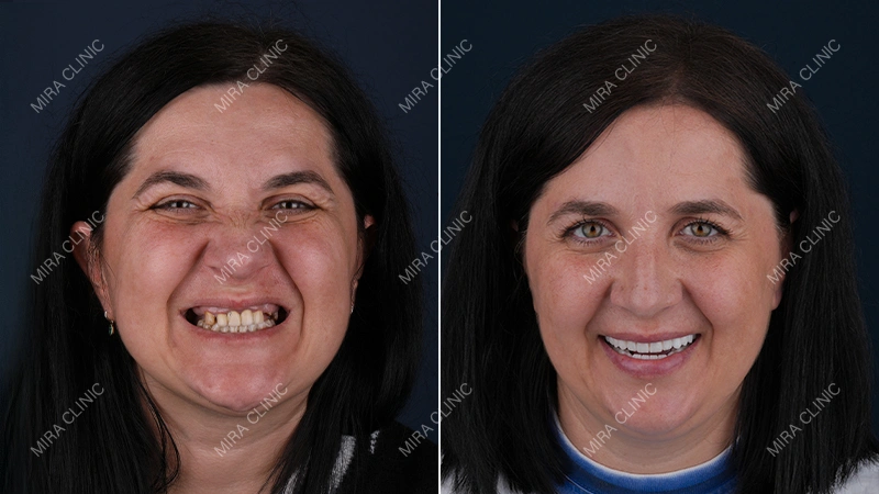 better-looking smile
